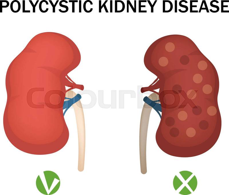 Foto de stock de riñón, diálisis, trasplante