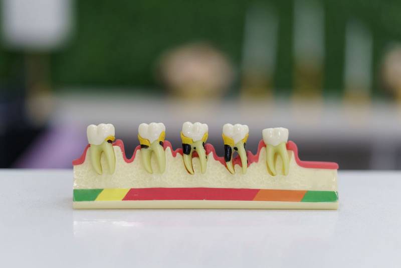 molars, gums and roots, didactic article for teaching